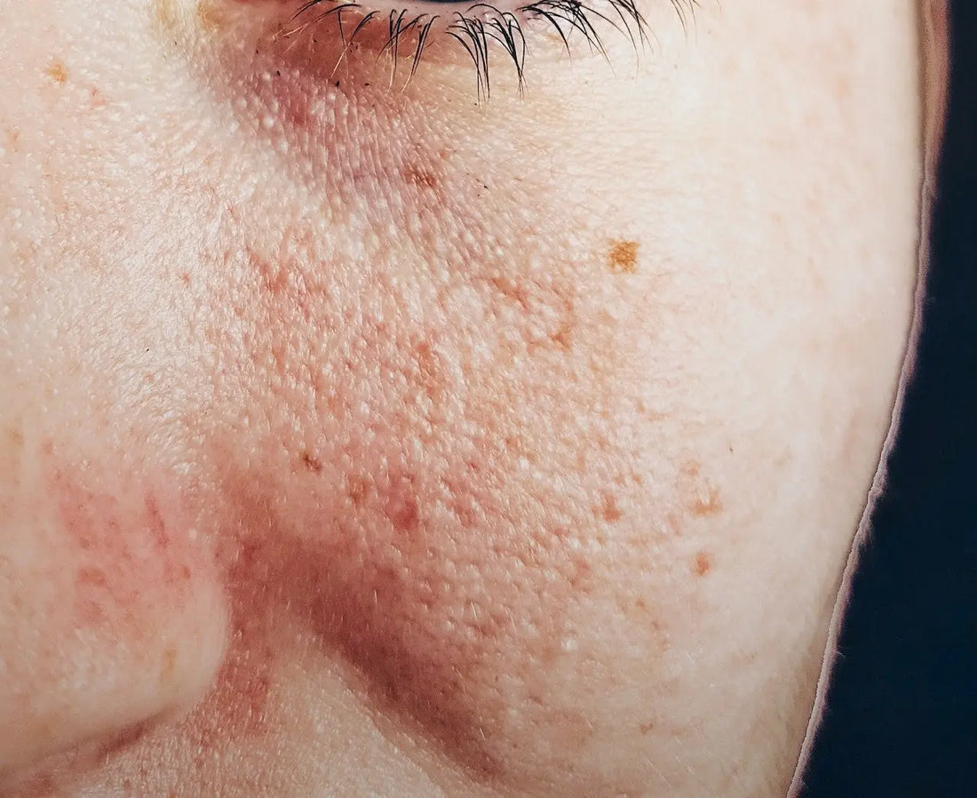 see how it can help: matcha for acne and matcha for rosacea